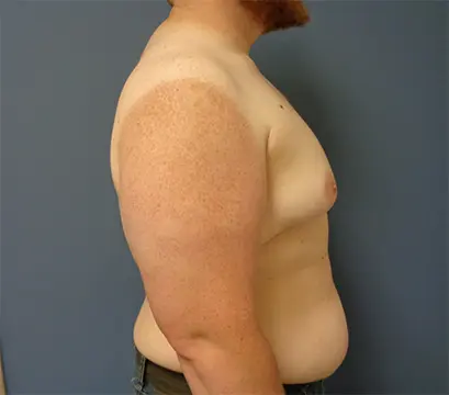 Gynecomastia Before and After Pictures Nashville, TN