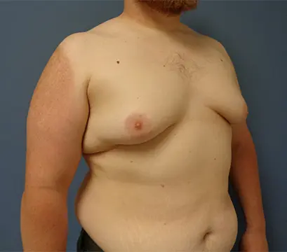 Gynecomastia Before and After Pictures Nashville, TN