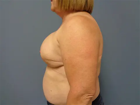 Implant Exchange/Removal Before and After Pictures Nashville, TN