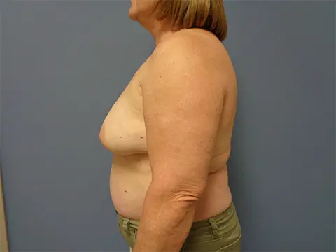 Implant Exchange/Removal Before and After Pictures Nashville, TN