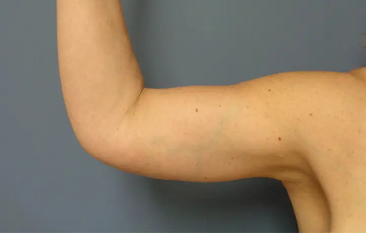 Arm Lift Before and After Pictures Nashville, TN