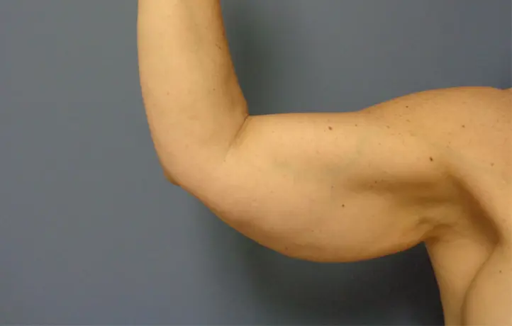 Arm Lift Before and After Pictures Nashville, TN