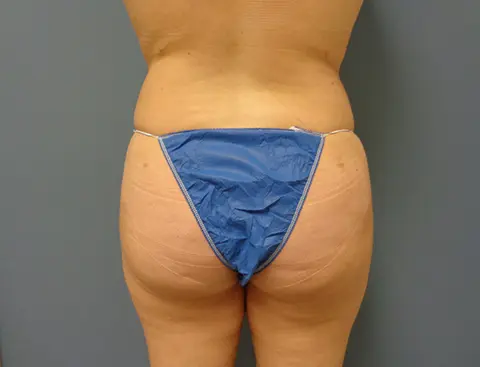 Butt Augmentation Before and After Pictures Nashville, TN