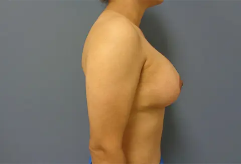 Mommy Makeover Before and After Pictures Nashville, TN