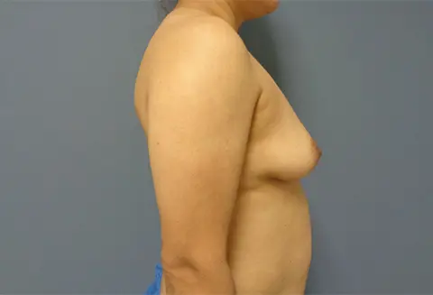Mommy Makeover Before and After Pictures Nashville, TN