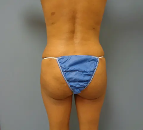 Butt Augmentation Before and After Pictures Nashville, TN