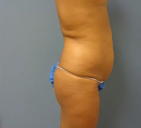 Butt Augmentation Before and After Pictures Nashville, TN