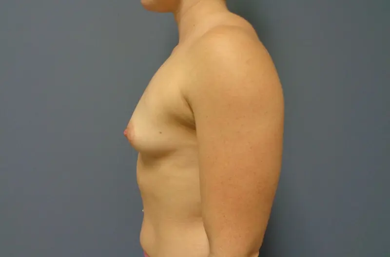 Breast Augmentation Before and After Pictures Nashville, TN