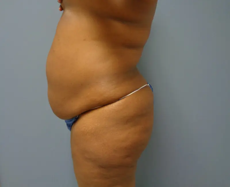 Tummy Tuck Before and After Pictures Nashville, TN