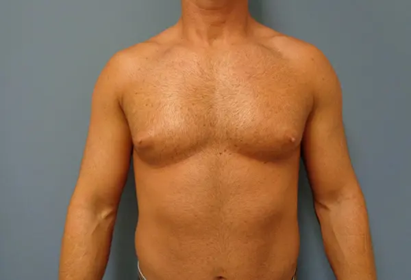 Gynecomastia Before and After Pictures Nashville, TN