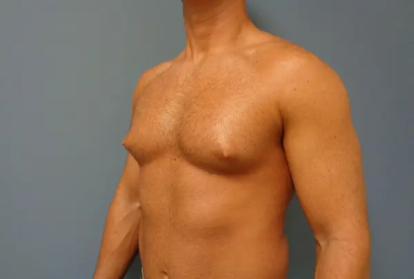 Gynecomastia Before and After Pictures Nashville, TN