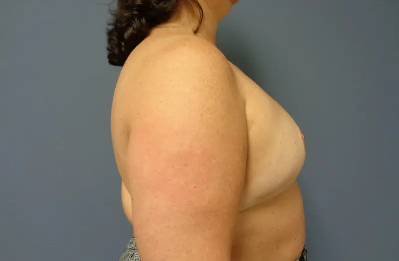 Implant Based Reconstruction Before and After Pictures Nashville, TN
