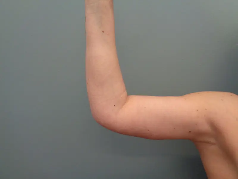 Arm Lift Before & After Pictures in Nashville, TN
