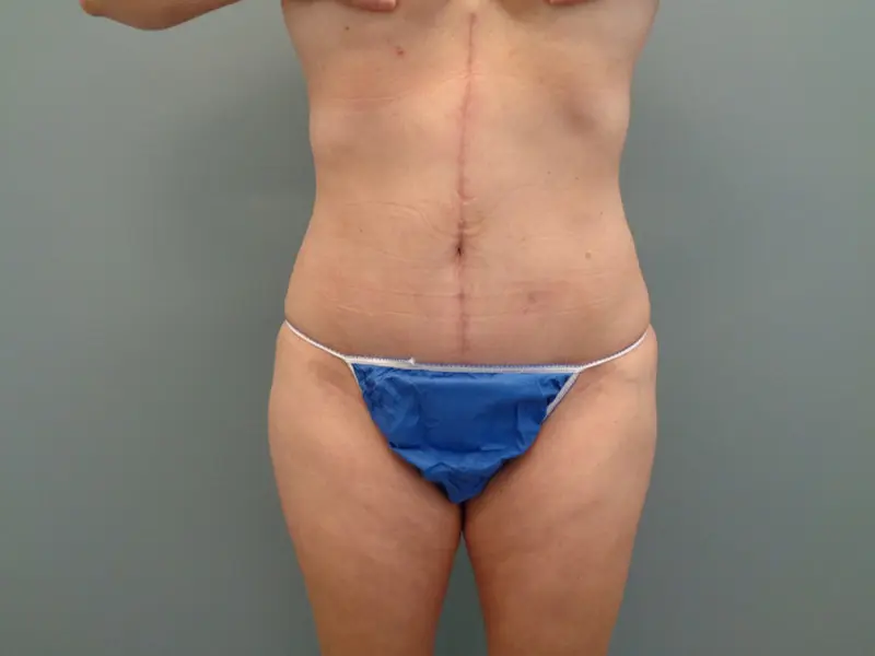 Abdominoplasty Before & After Pictures in Nashville, TN