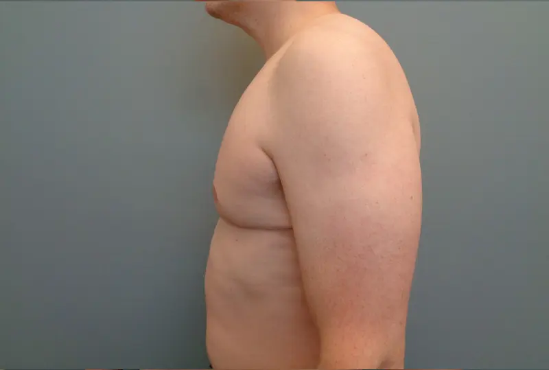 Gynecomastia Before & After Pictures in Nashville, TN