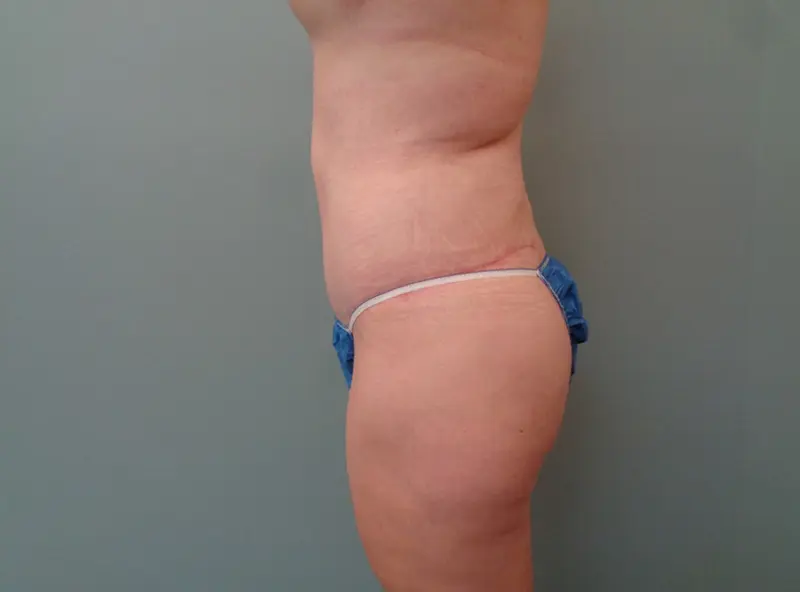 Abdominoplasty Before & After Pictures in Nashville, TN