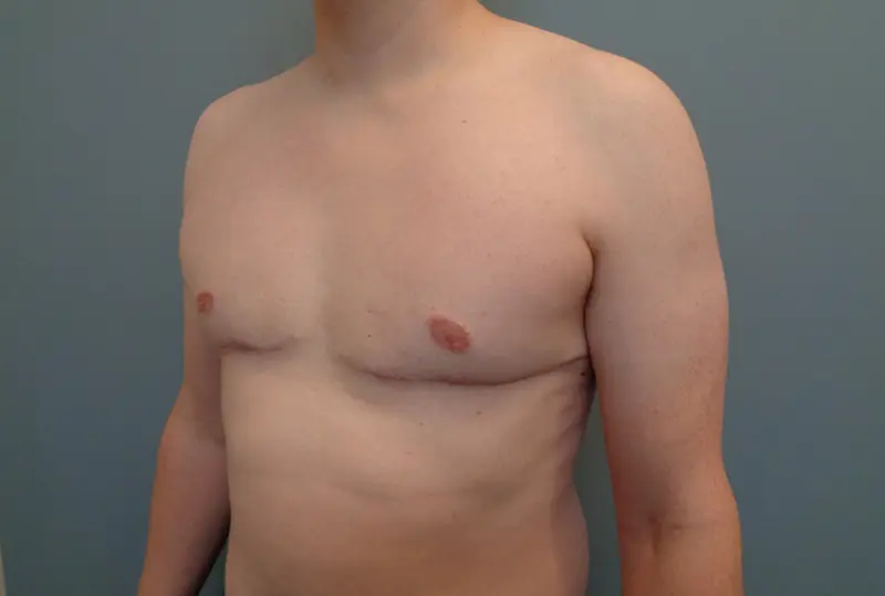 Gynecomastia Before & After Pictures in Nashville, TN