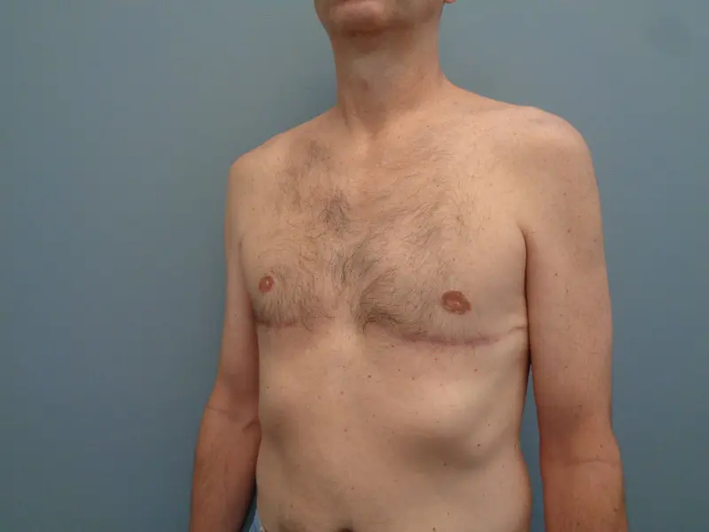 Gynecomastia Before & After Pictures in Nashville, TN