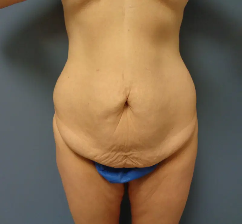 Tummy Tuck with Lift Before & After Pictures in Nashville, TN