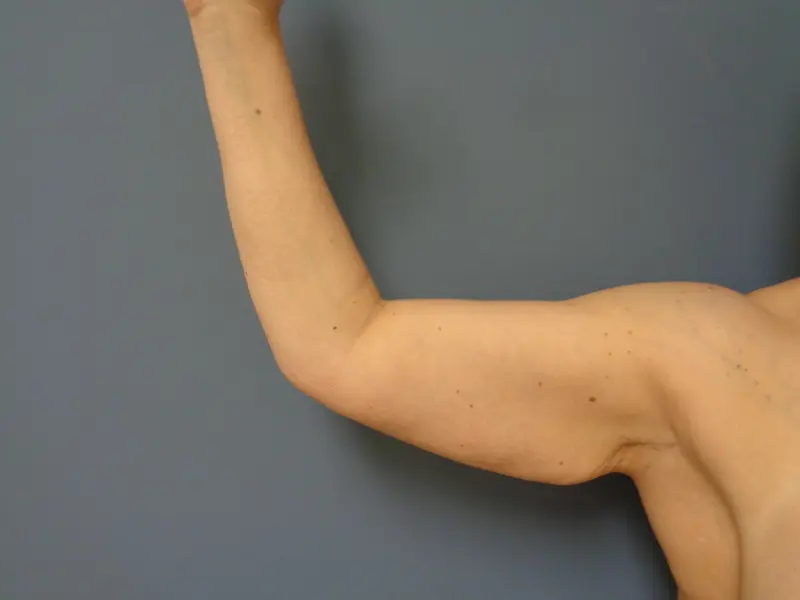 Arm Lift Before & After Pictures in Nashville, TN