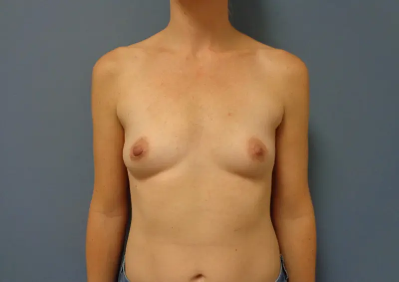 Breast Augmentation Before & After Pictures in Nashville, TN