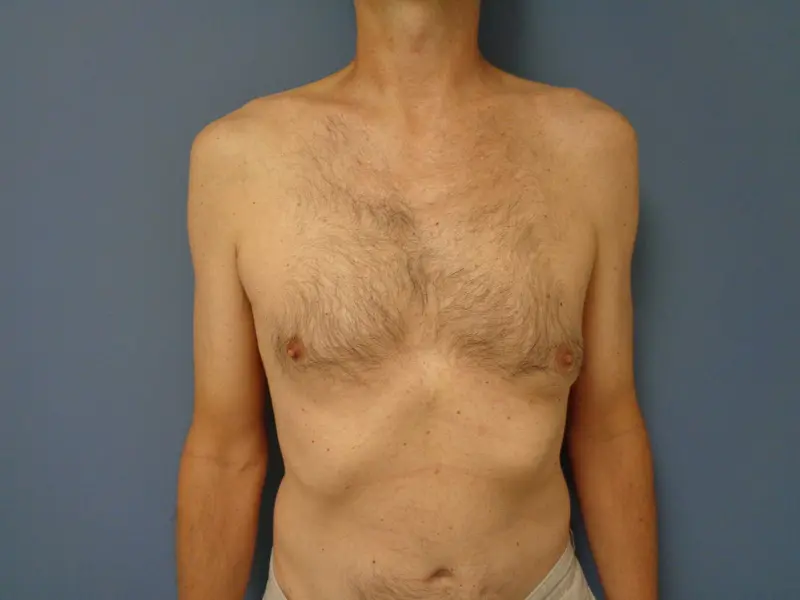 Gynecomastia Before & After Pictures in Nashville, TN