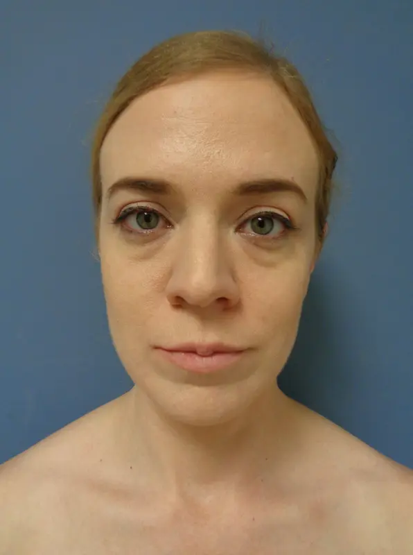 Rhinoplasty Before & After Pictures in Nashville, TN