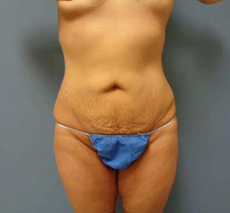 Mommy Makeover Before & After Pictures in Nashville, TN