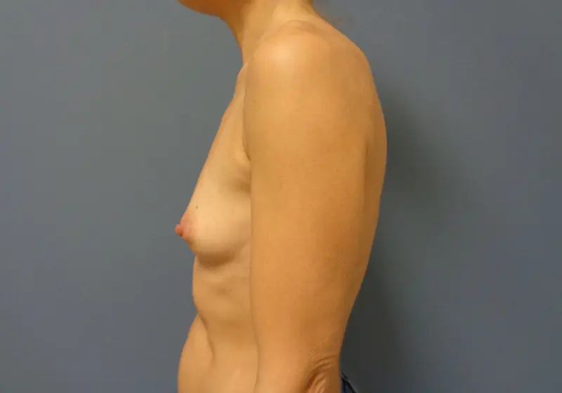 Breast Augmentation Before & After Pictures in Nashville, TN