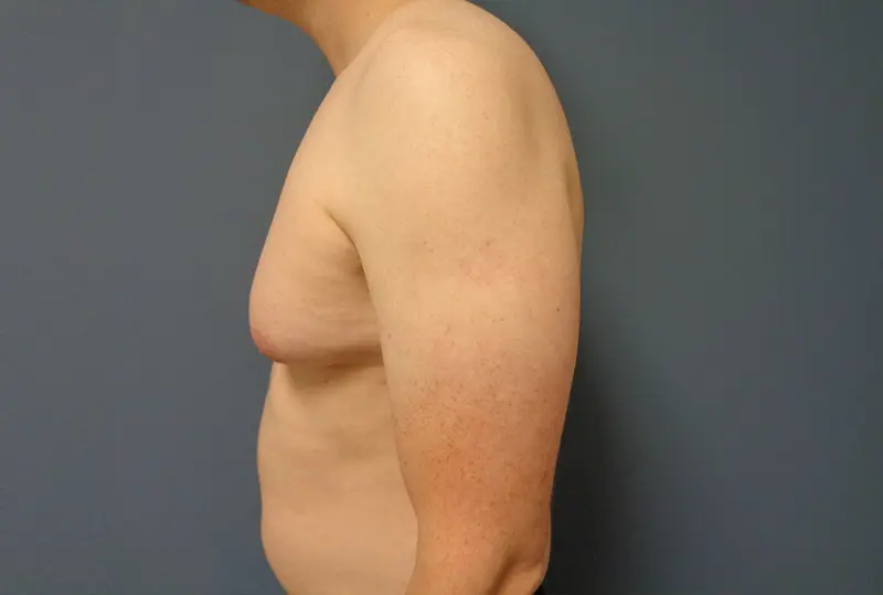 Gynecomastia Before & After Pictures in Nashville, TN