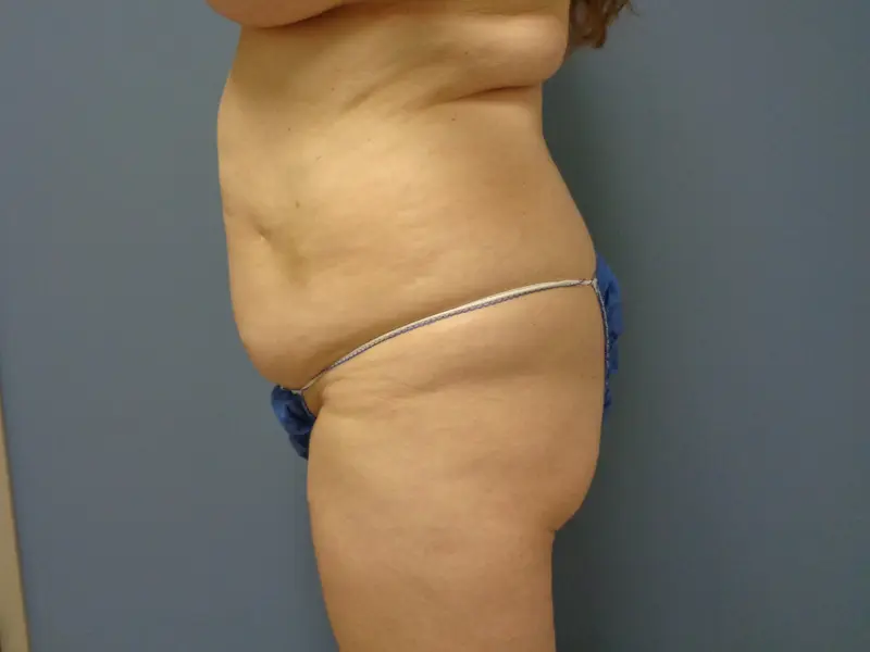Abdominoplasty Before & After Pictures in Nashville, TN