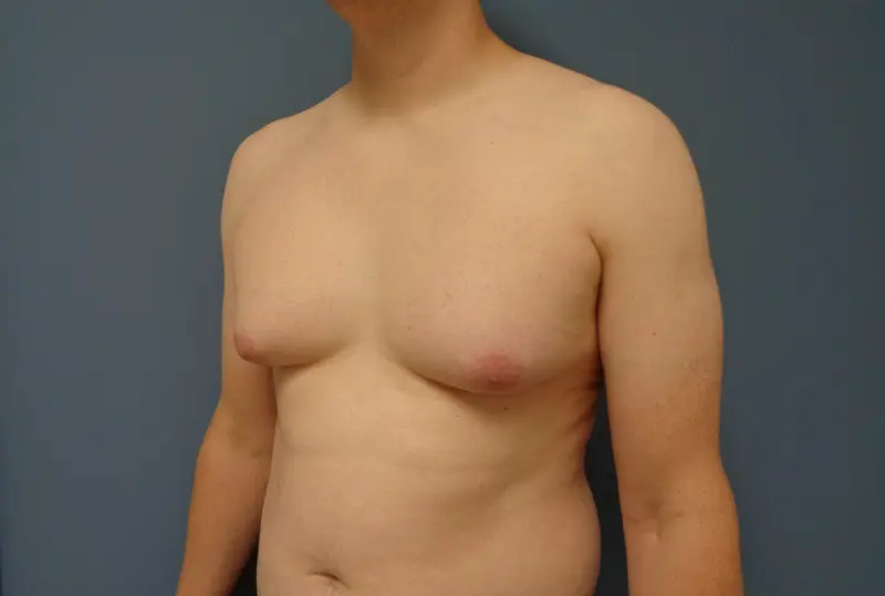 Gynecomastia Before & After Pictures in Nashville, TN