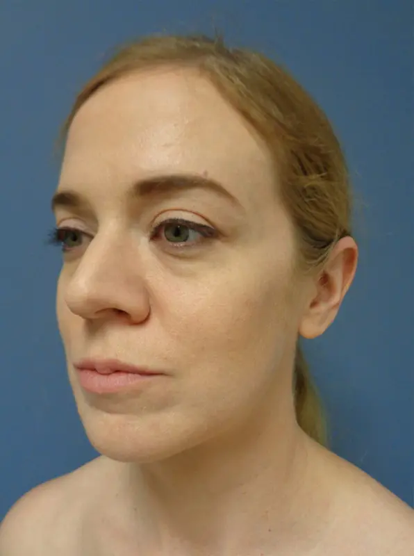 Rhinoplasty Before & After Pictures in Nashville, TN