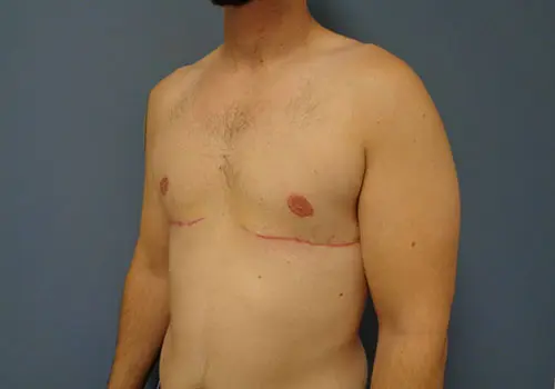 Gynecomastia Before & After Pictures in Nashville, TN