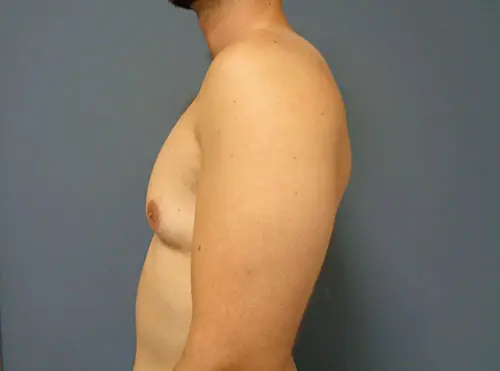 Gynecomastia Before & After Pictures in Nashville, TN