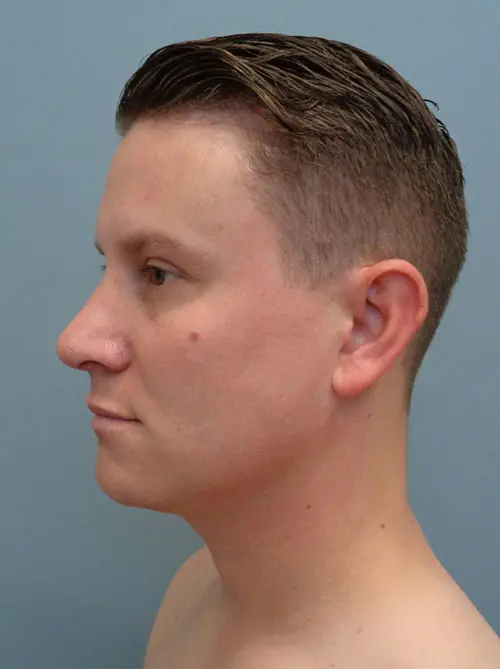 Rhinoplasty Before & After Pictures in Nashville, TN