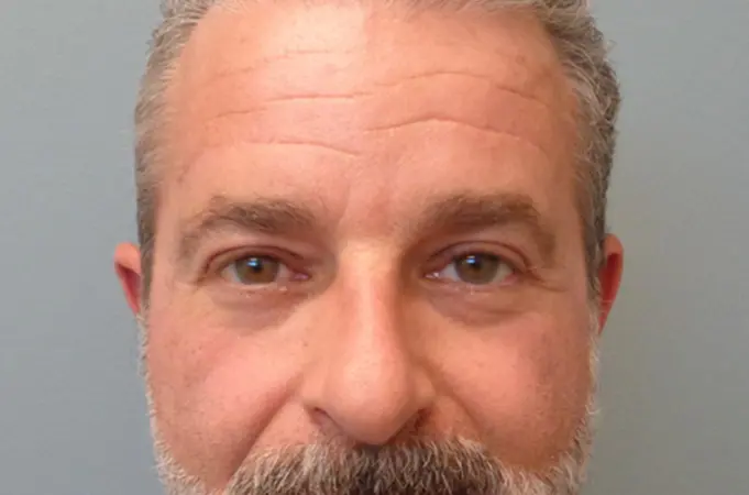 Blepharoplasty Before & After Pictures in Nashville, TN