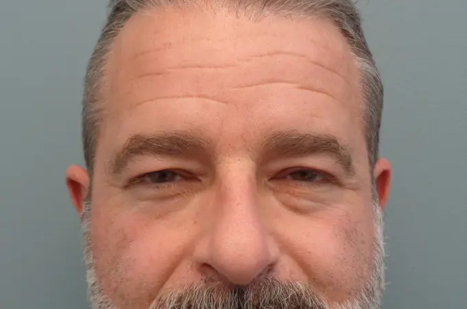 Blepharoplasty Before & After Pictures in Nashville, TN