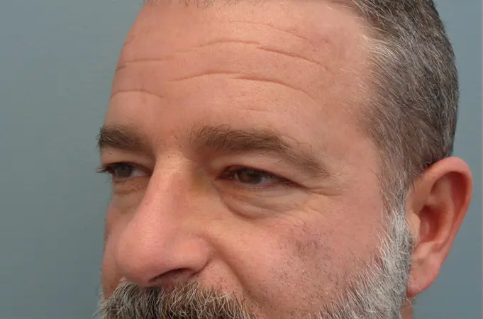 Blepharoplasty Before & After Pictures in Nashville, TN