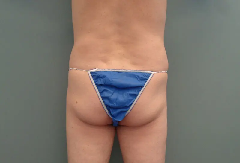 Butt Augmentation Before & After Pictures in Nashville, TN