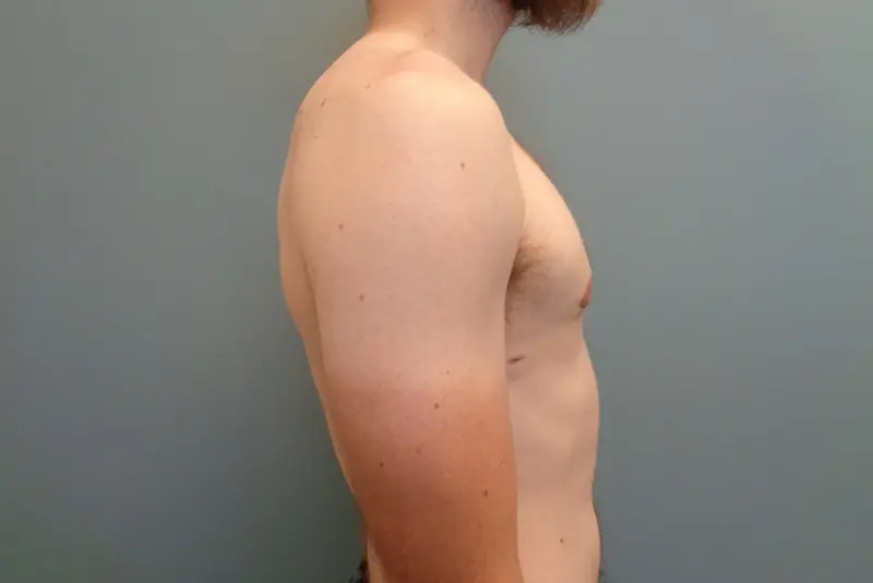 Gynecomastia Before & After Pictures in Nashville, TN