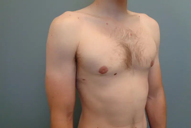 Gynecomastia Before & After Pictures in Nashville, TN