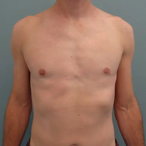 Gynecomastia Before & After Pictures in Nashville, TN