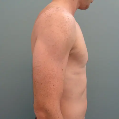 Gynecomastia Before & After Pictures in Nashville, TN