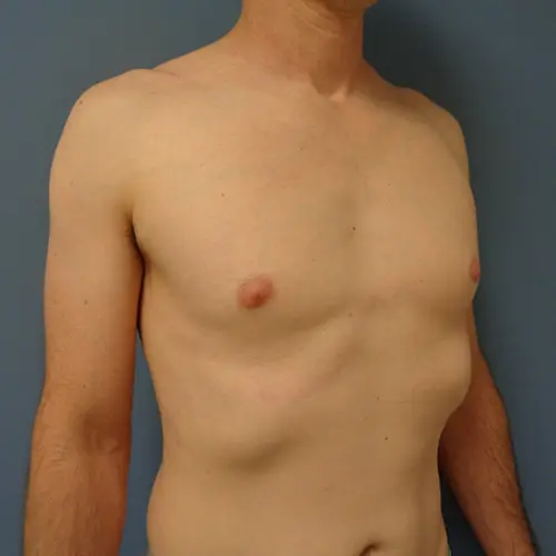 Gynecomastia Before & After Pictures in Nashville, TN