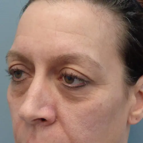 Blepharoplasty Before & After Pictures in Nashville, TN