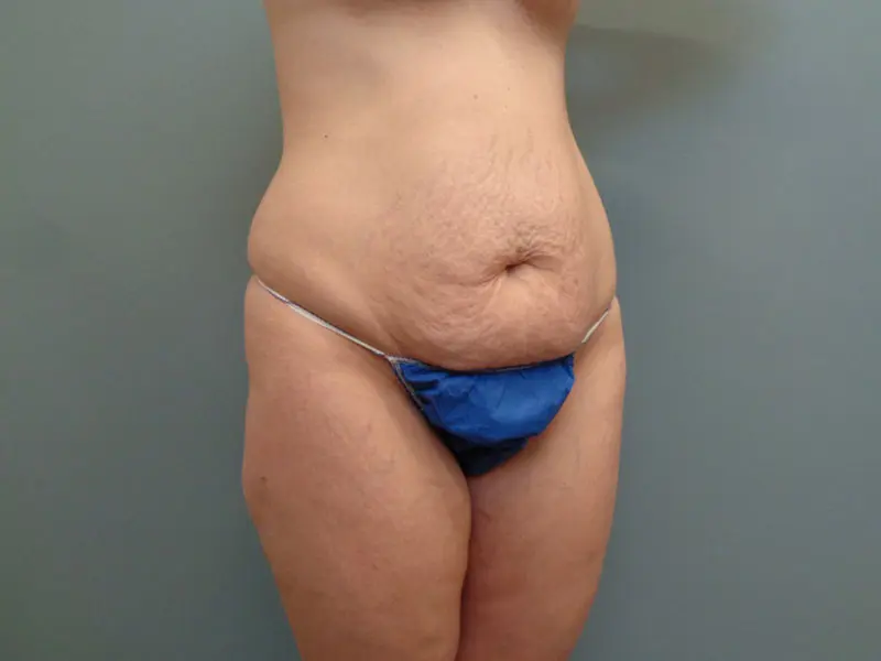 Mommy Makeover Before & After Pictures in Nashville, TN