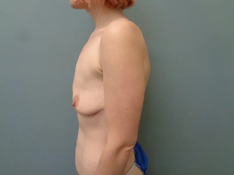Mommy Makeover Before & After Pictures in Nashville, TN