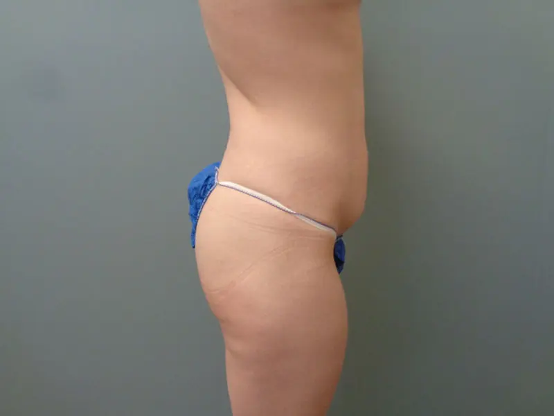 Mommy Makeover Before & After Pictures in Nashville, TN