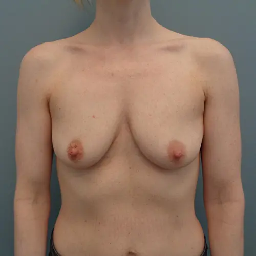 Breast Augmentation Before & After Pictures in Nashville, TN